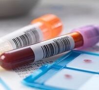 Prostatīta laboratoriskā diagnoze