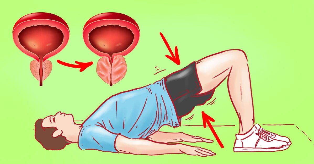 Hroniska prostatīta terapeitiskie vingrinājumi