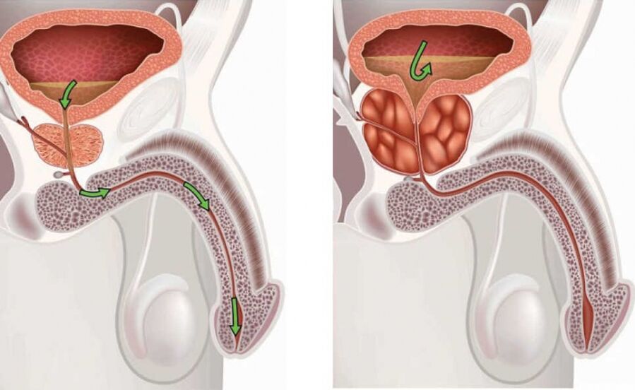 vesels un iekaisis prostatas dziedzeris