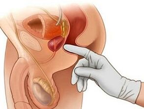 Prostatas masāža prostatīta ārstēšanai vīriešiem