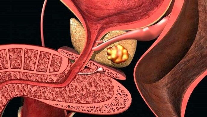 Akmens nogulsnes priekšdziedzerī ar calculous prostatītu
