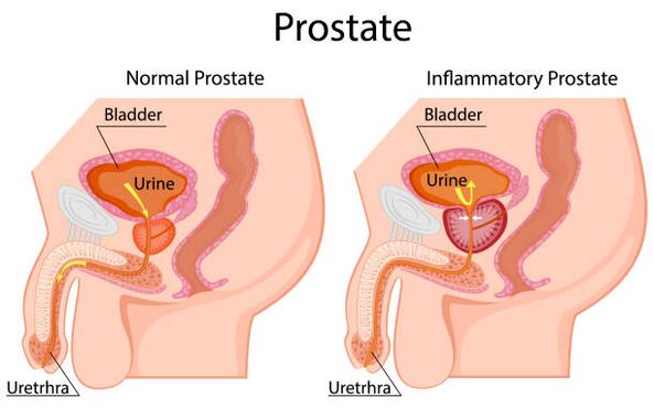 veselīga un iekaisusi prostata
