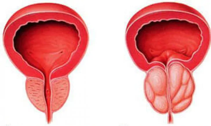 Normāla prostata (pa kreisi) un iekaisis hronisks prostatīts (pa labi)