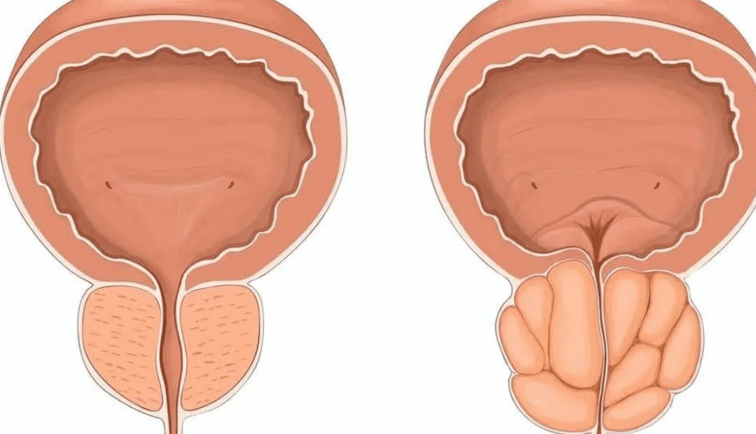 vesela un slima prostata