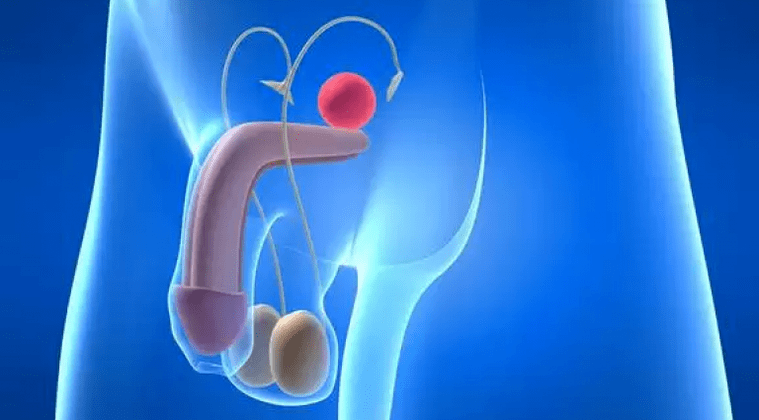 Prostatīts ir prostatas dziedzera iekaisums vīriešiem, kam nepieciešama sarežģīta ārstēšana